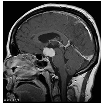 craniofaringioma.jpg